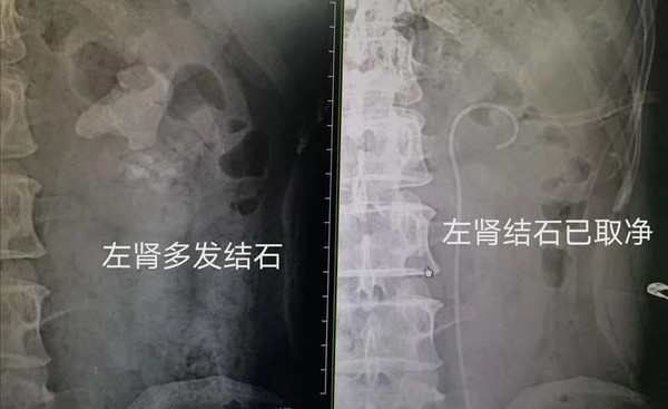 ▲男上班族手術取出1258顆腎結石。（圖／翻攝自長春晚報，下同）