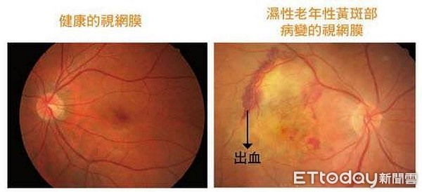 ▲安南醫院眼科主任徐聖曜醫師表示，看東西時物象扭曲，一定要到醫院作詳細檢查是否有視網膜黃斑部病變。（圖／記者林悅翻攝，下同）