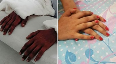 印度女孩雙臂移植「黑鋼砲」驚人結果　1年後膚色迅速褪淡
