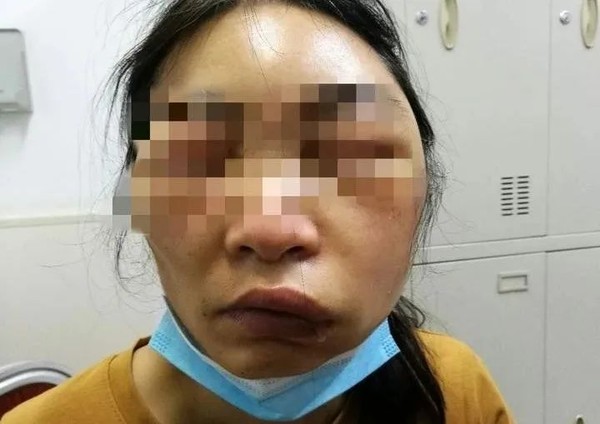 ▲杭州一名小姐被蟲叮咬臉部腫脹。（圖／翻攝自杭州日報，下同）