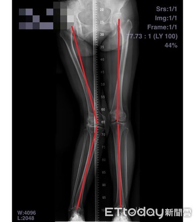 ▲台南市立安南醫院骨科許惟傑醫師表示，國人常見退化性關節炎以「膝內翻」（O型腿）為主，「膝外翻」（X型腿）較少見=力且手術難度高。（圖／記者林悅翻攝，下同）