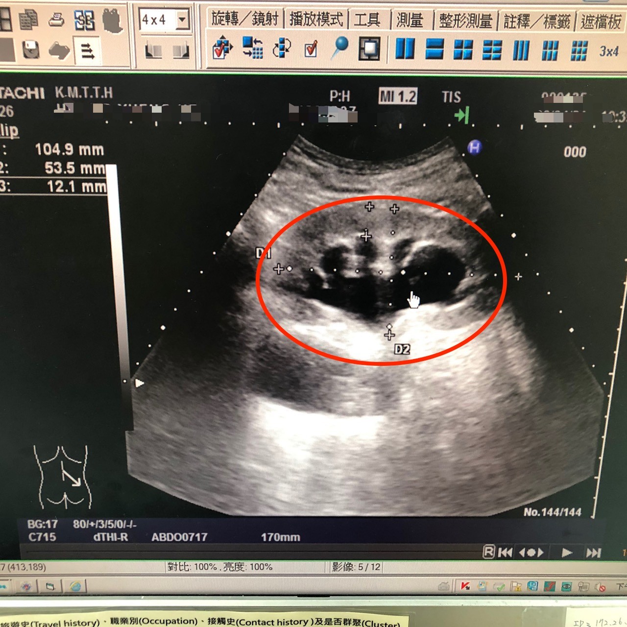 超音波掃描驚見他 腎臟有嬰影 估有0 1公斤醫雷射 摘除 搶命 Ettoday健康雲 Ettoday新聞雲