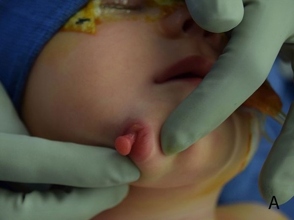 女嬰長出第二張2公分小嘴　有舌頭牙齒還會流口水。（圖／翻攝自BMJ Case Reports）