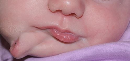 ▲▼美國一名小女嬰竟有兩張嘴唇，其中更挖出多顆牙齒。（圖／翻攝自BMJ）