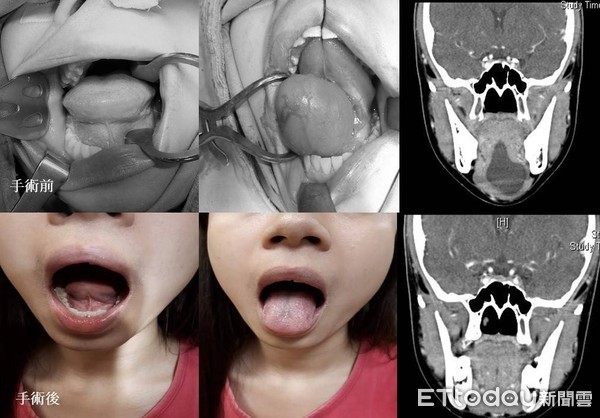 ▲ 嘴巴含滷蛋--讓你有話說不清的口腔底部囊腫         。（圖／記者翁伊森翻攝）