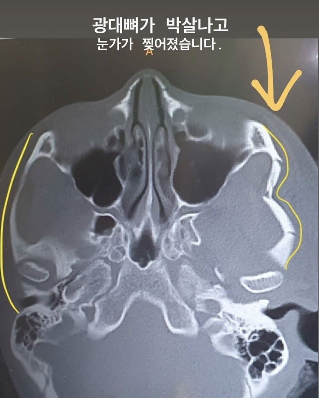 ▲▼女子被毆打到顴骨破裂、眼角皮膚撕裂傷。（圖／翻攝自Instagram@j_yunjeong_）