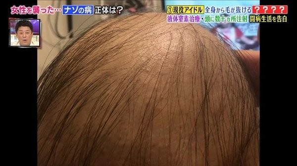 ▲pippi一開始只掉一點頭髮。（圖／翻攝自fnn.jp）