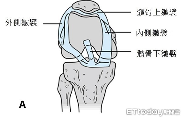 ▲張志偉醫師強調，並非所有膝關節的疼痛失能與活動限制，都能以膝內皺襞症候來做解釋與處理，仍需詳細評估與專業判斷治療方式。（圖／記者林悅翻攝，下同）