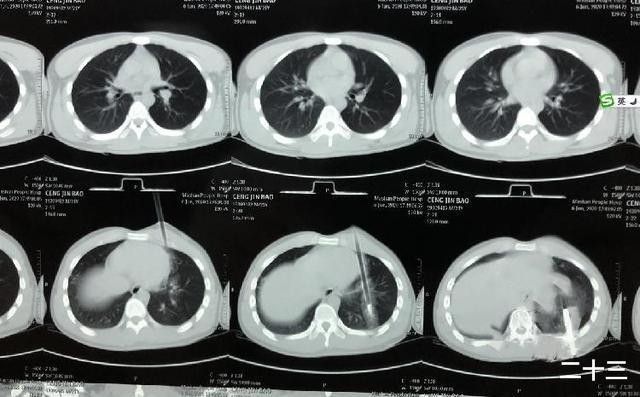 ▲▼年輕男被弓箭穿心。（圖／翻攝自微博）