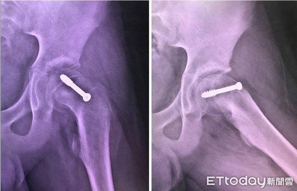 ▲胖弟弟的難言之痛!鼠蹊部疼痛跛腳 小心「骨骺板滑脫」引起骨壞死及關節炎          。（圖／記者翁伊森翻攝）