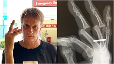 駭人X光片「手指找到新方向」　滑板神東尼霍克說不痛：我愛我的工作