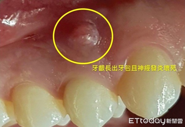 ▲奇美醫學中心牙醫部牙髓病科醫師郭祉吟指出，一個品質良好的根管治療以及治療後完整封填的牙冠，會使牙包消失且被破壞的骨頭癒合。（圖／記者林悅翻攝，下同）