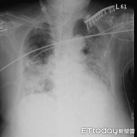 北榮說明新冠肺炎患者。（圖／記者趙于婷攝）