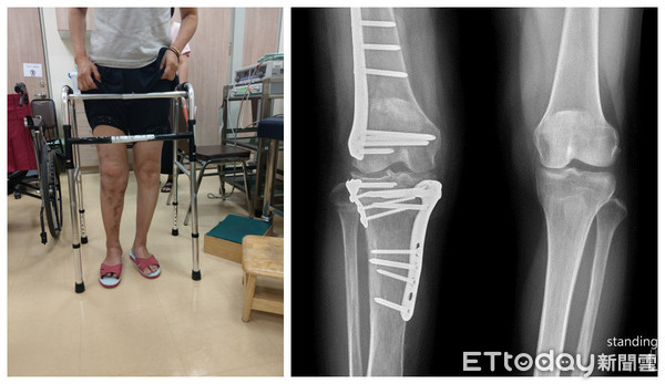 ▲台南市立安南醫院6年多來，已完成70例以上四肢變形的截骨矯正, 其中有3成病患是屬於10年以上之骨折後變形，造福病患。 （圖／記者林悅翻攝，下同）
