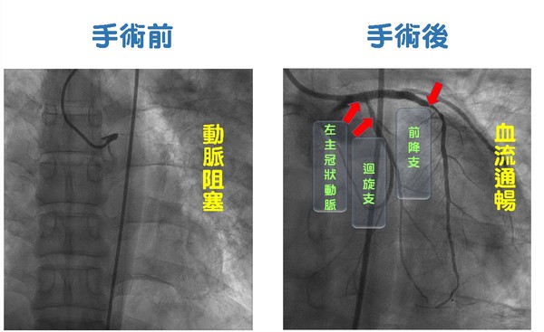 ▲▼心肌梗塞。（圖／中國醫藥大學心竹附設醫院提供）