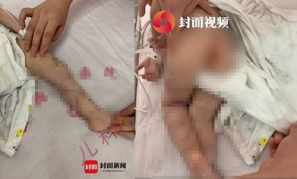 ▲成都一名1歲男童被媽媽打傷住院。（圖／翻攝自封面新聞）