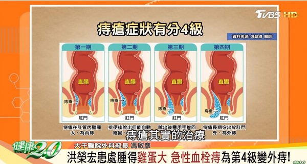 ▲▼痔瘡分4級。（圖／截自健康2.0）