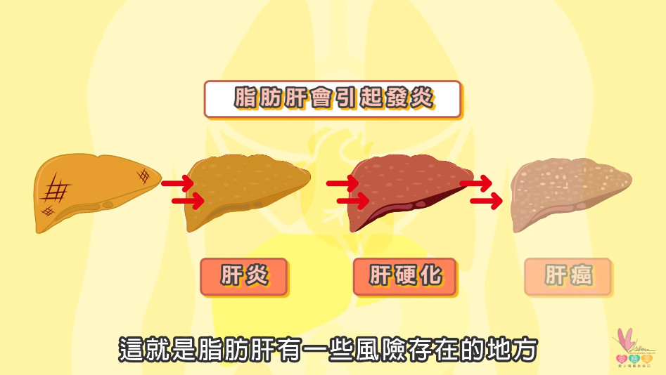 瘦子也會得！醫曝「害肝臟泡油」超地獄成分…4部曲恐慢慢癌化。（圖／截自邱正宏醫師Youtube）