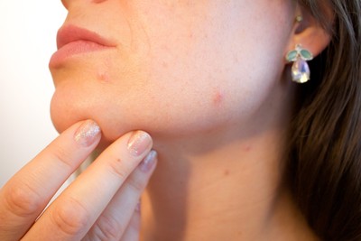 「月經前狂冒痘痘」原因揭曉了！70％女性都會　頭皮也變油