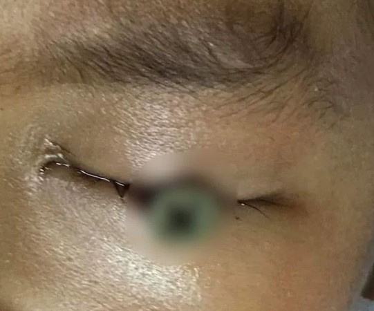 ▲▼3歲男童眼睛慘遭螺絲釘插入。（圖／翻攝自jangkhao.org）