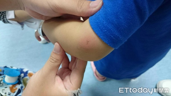 發燒1個多月！3歲女童罹「致命性疾病」紅疹爬四肢　醫驚：非常非常少見。（圖／中國醫藥大學兒童醫院提供）