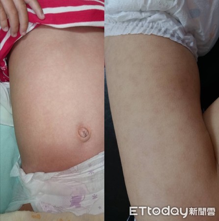 發燒1個多月！3歲女童罹「致命性疾病」紅疹爬四肢　醫驚：非常非常少見。（圖／中國醫藥大學兒童醫院提供）