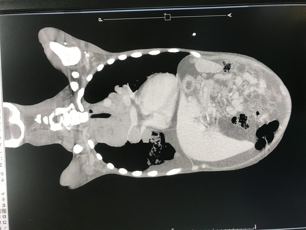 ▲▼19歲少年罹患何杰金氏淋巴瘤第4期，經手術成功救回。（圖／烏日林新醫院提供）