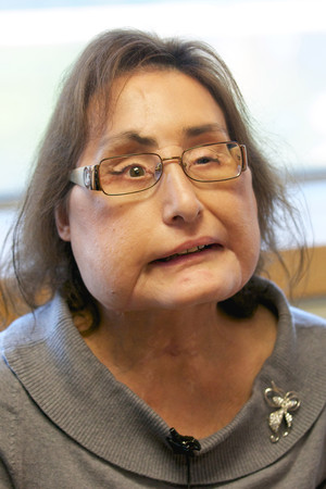 ▲全美首名接受臉部移植手術的患者康妮．庫爾普（Connie Culp）去世，享年57歲。（圖／達志影像／美聯社）