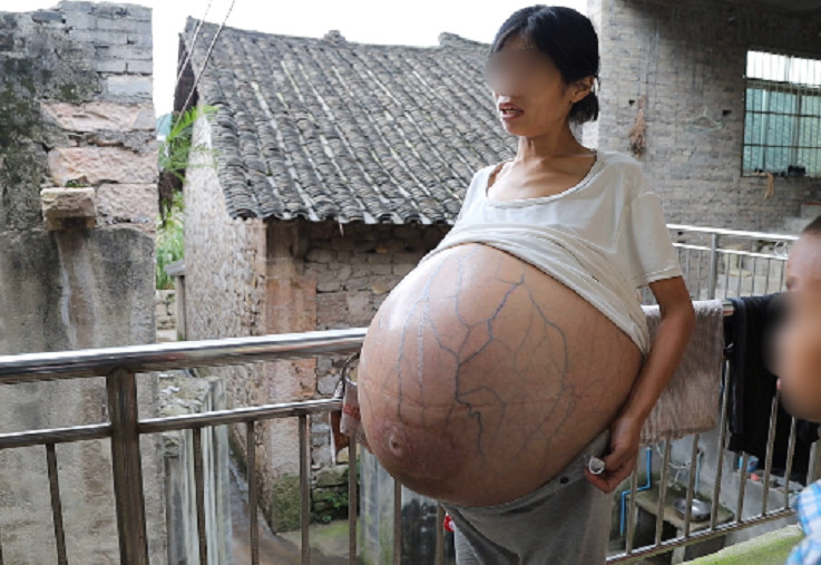 ▲▼ 女子肚子2年瘋長成40斤巨球只能坐著睡覺。（圖／光明網）