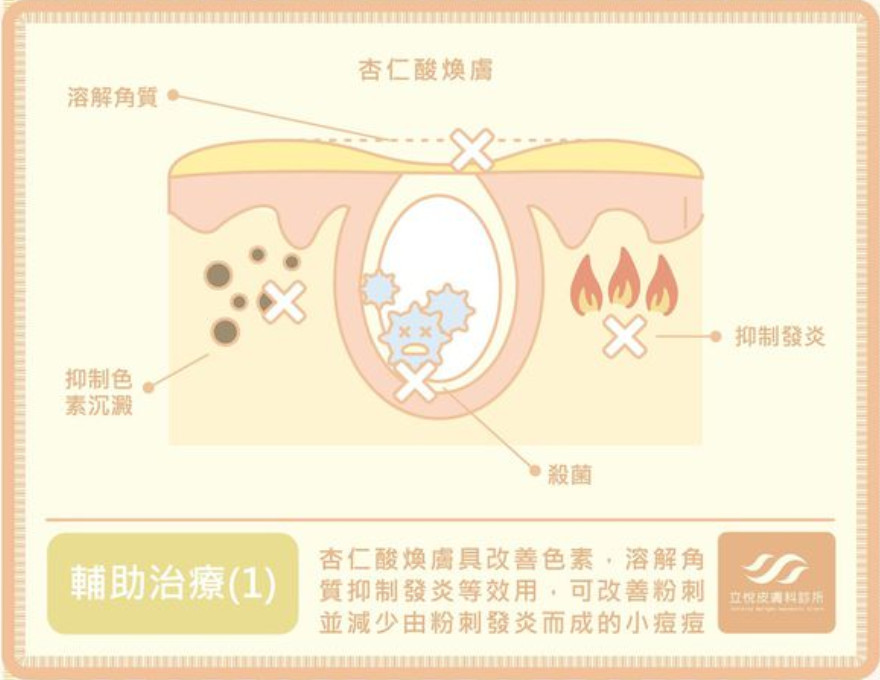 老妹還在長痘痘！醫曝「3致痘原因」痛到爆：少喝含糖飲料。（圖／莊德揚醫師授權）