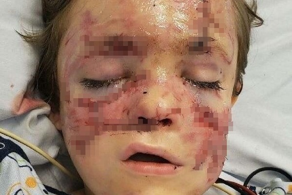▲▼ 美國一名6歲男童坎登（Camdon Bozbell）在家突然遭到比特犬攻擊。（圖／翻攝自gofundme）
