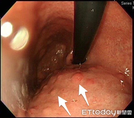 拉肚子半年！她一照胃鏡…醫見20顆「粉色肉瘤」狂襲傻了：要切除全胃。（圖／錢政弘醫師授權提供）