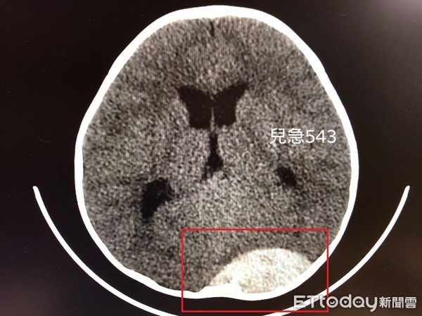 衝刺撞門…下秒倒頭栽！1歲半娃凌晨「詭異半癱」　醫見「大腦整塊白」驚呆。（圖／吳昌騰醫師授權提供）