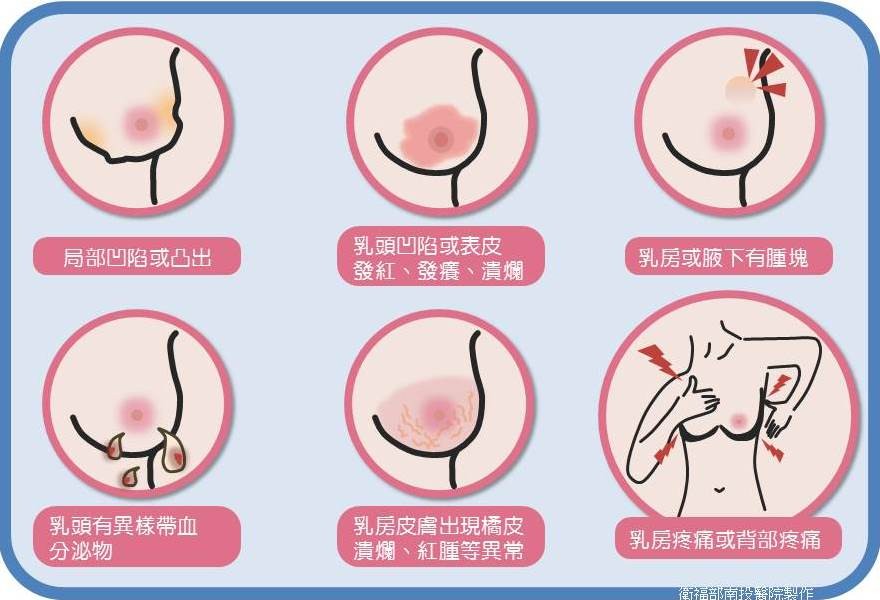 乳頭癢爆！她「抓到破皮」…6個月後慘罹乳癌　醫曝有6症狀別再拖了。（圖／南投醫院提供）