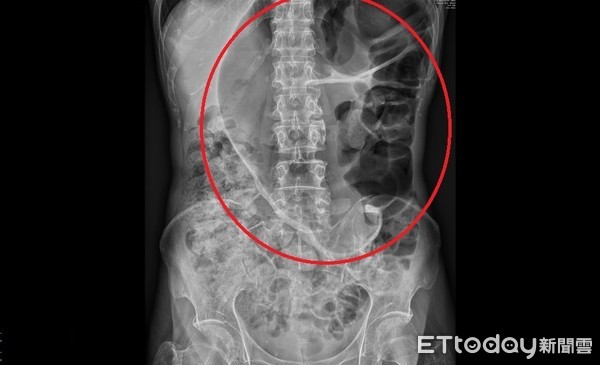 ▲黃男腹部X光顯示有咖啡豆狀的異常氣體分佈(紅圈處)，確診為乙狀結腸扭轉造成腸阻塞。（圖／記者黃孟珍翻攝）