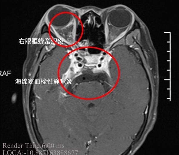 ▲▼19歲女擠痘引发顱內感染。（圖／翻攝自中國寧波網）