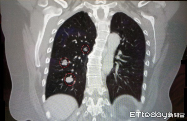 ▲劉女因子宮內膜癌轉移肺腫瘤（紅圈處），經單孔胸腔鏡手術切除肺葉，恢復狀況良好。（圖／記者黃孟珍翻攝）