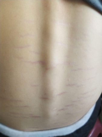 ▲台南一名媽媽在在社團詢問，兒子的背部為何出現紫色痕條。（圖／翻攝自facebook／正港善化人）