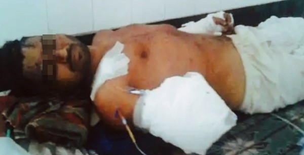 ▲印度北方邦（Uttar Pradesh）男子薩爾瑪尼（Akhlaq Salmani）前臂遭鋸斷。（圖／Twitter@SakibulHoque8）