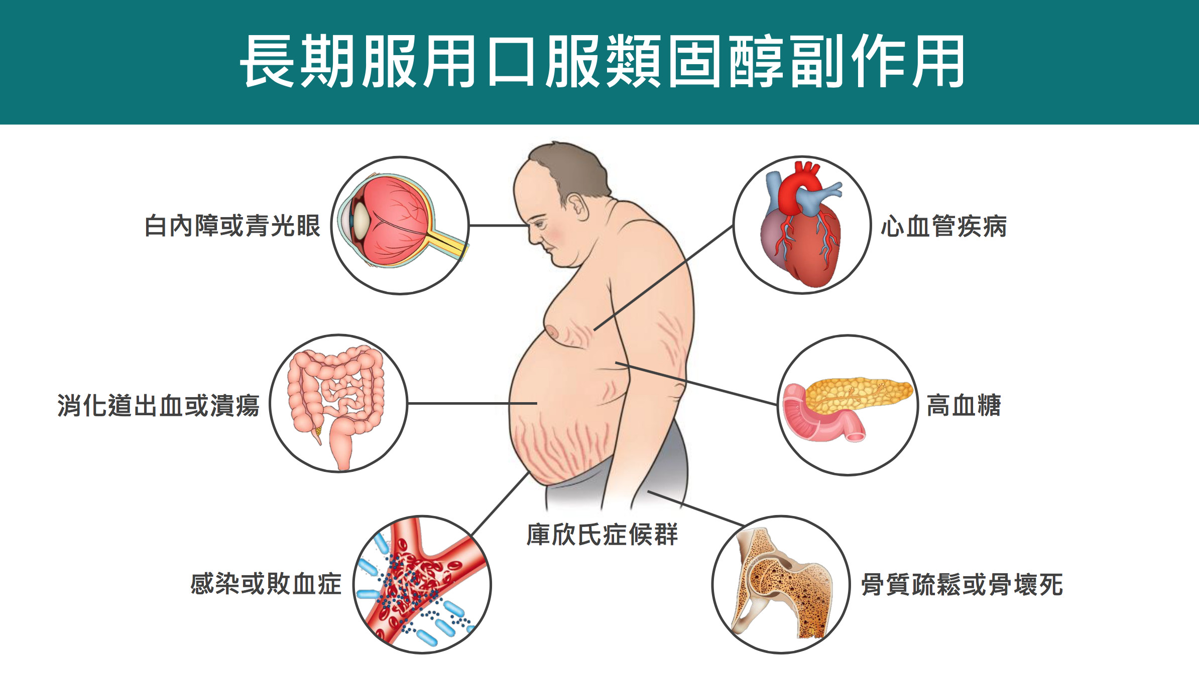 口服類固醇 吃短期 也有副作用敗血症 心衰竭風險增2倍 Ettoday健康雲 Ettoday新聞雲