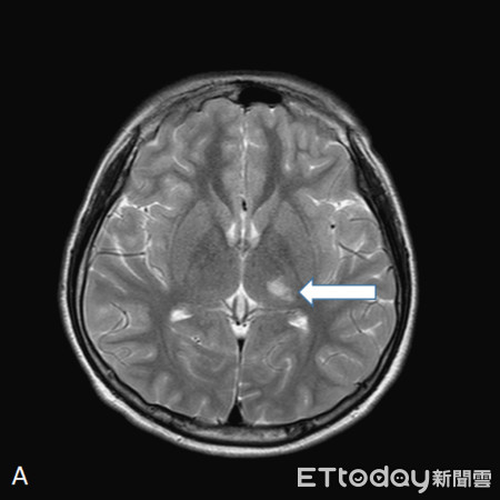 ▲少年住院時經腦部磁振造影檢查，顯示左側丘腦缺血梗塞(箭頭處)。（圖／翁根本醫師提供）