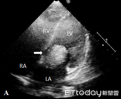 ▲心臟超音波顯示少年左心房有顆巨大心臟腫瘤(箭頭處)。（圖／翁根本醫師提供）