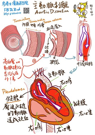 ▲▼主動脈剝離。（圖／鳥博士提供）