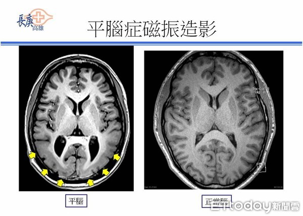 平腦症。（圖／記者趙于婷攝）