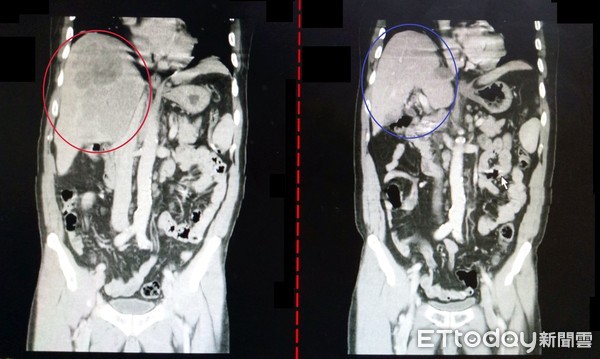 ▲林男原有14公分大的肝腫瘤(左圖紅圈處)，經肝動脈化療後，縮小到幾乎消失。（圖／記者黃孟珍翻攝）