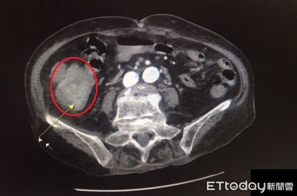 ▲93歲的黃奶奶腫瘤體積大（如紅圈所示），幾乎完全阻塞腸道，經微創手術後，順利恢復健康。（圖／記者黃孟珍翻攝）