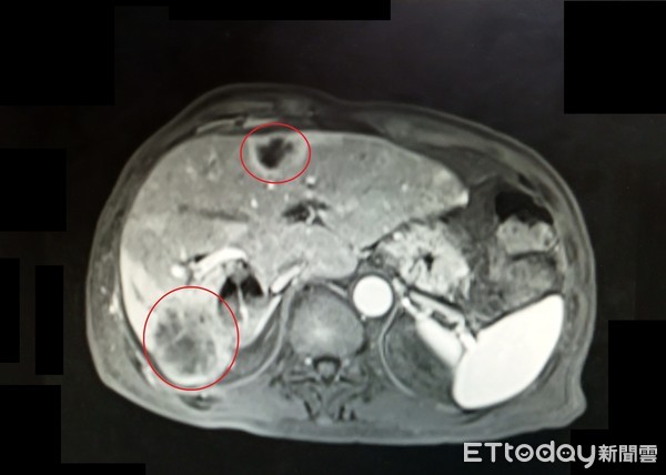 ▲許男因肝內管癌（下方紅圈處）影響，導致肝膿瘍（上方紅圈處）無法治癒。（圖／記者黃孟珍翻攝）