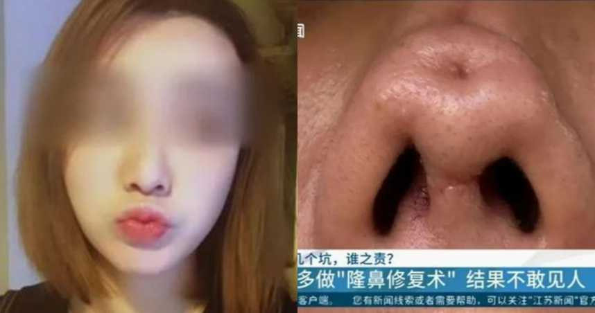 網紅花10萬隆鼻 歷經4回手術 凹大洞 鼻頭歪扭變形毀容 Ettoday大陸新聞 Ettoday新聞雲