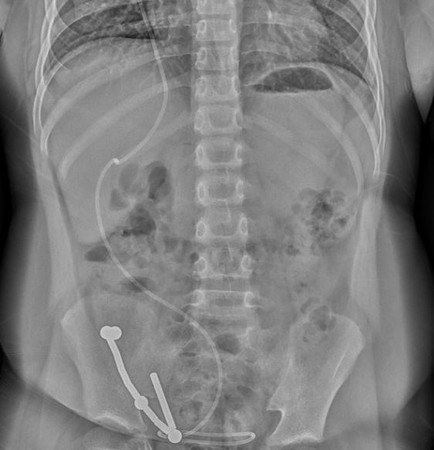 ▲台中一名男童連吐7天，X光一照竟發現大腸有多個磁條、鐵珠黏成一排。（圖／記者游瓊華攝）ㄔ