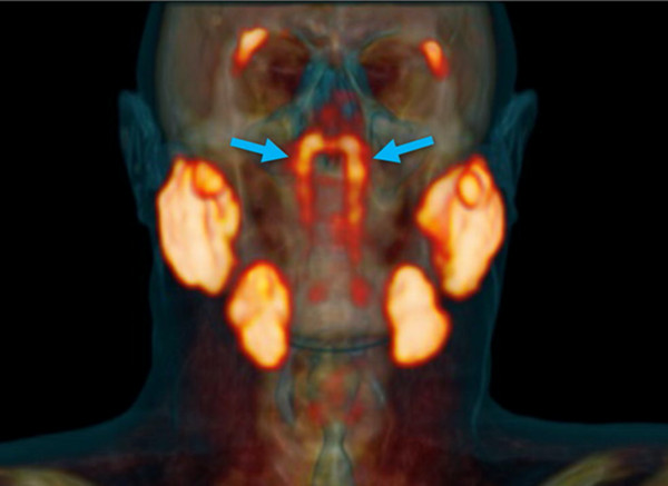 ▲▼ 根據荷蘭最新研究，人體鼻咽部後方藏有一對扁平細長腺體，很有可能是人類第4組主要唾液腺。（圖／翻攝自Radiotherapy & Oncology）